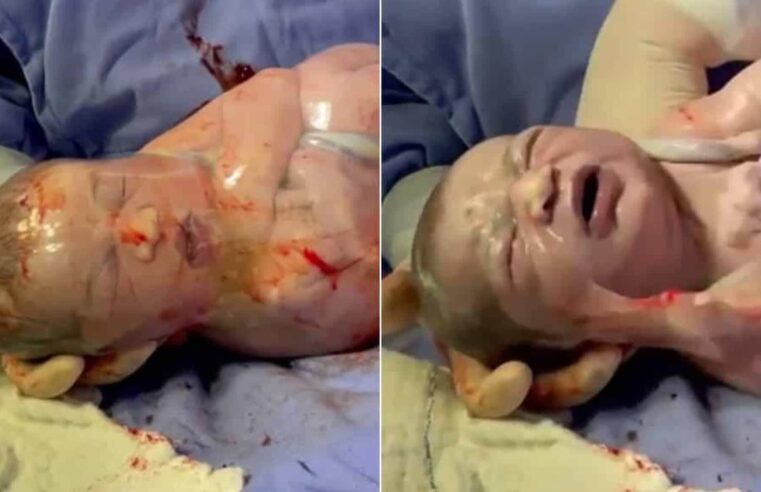 Bebê nasce envolto na bolsa e vídeo de médico rompendo viraliza