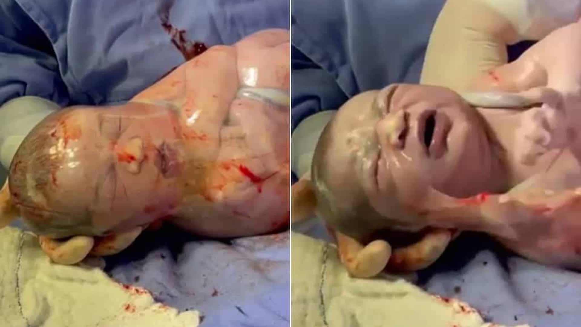 Bebê nasce envolto na bolsa e vídeo de médico rompendo viraliza