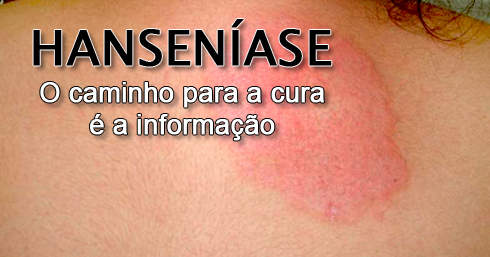 SES capacita Agentes Comunitários em Saúde sobre sinais e sintomas da hanseníase