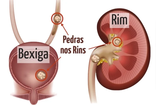 Médicos alertam para alta incidência de pedras nos rins no verão