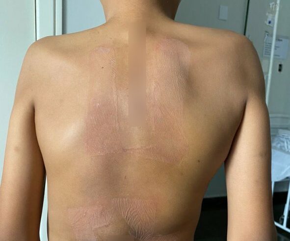 Menino de 11 anos passa por cirurgia rara em Cuiabá