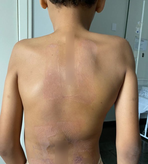 Menino de 11 anos passa por cirurgia rara em Cuiabá