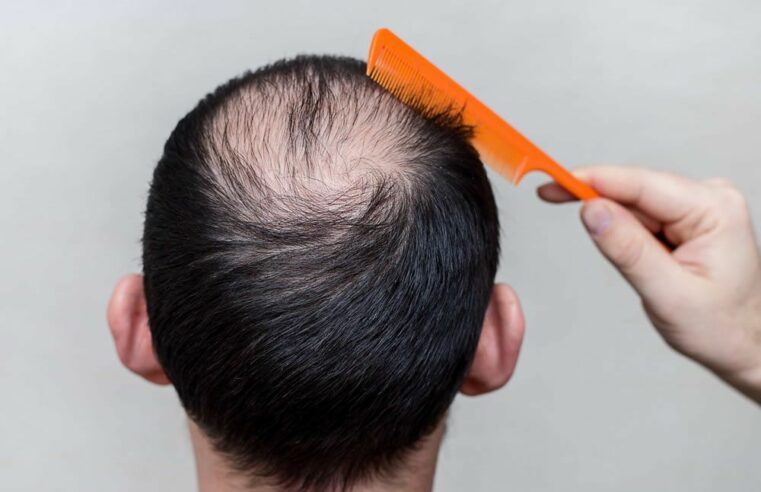 Pesquisa elenca melhores tratamentos para queda de cabelo masculino