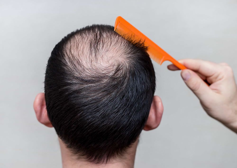 Pesquisa elenca melhores tratamentos para queda de cabelo masculino