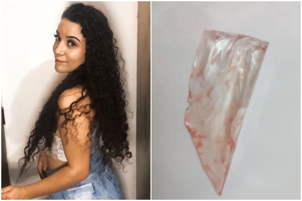 Jovem fica um mês com vidro de 5 cm enterrado nas costas em SP e médicos não percebem