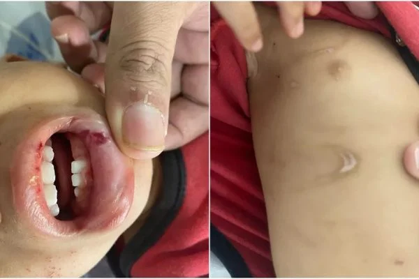 Bebê de 1 ano é internado com ferimentos e sinais de maus-tratos em GO