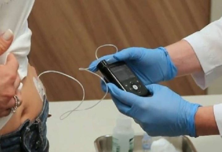 Inglaterra começa a testar pâncreas artificial em grande escala para pacientes com diabetes
