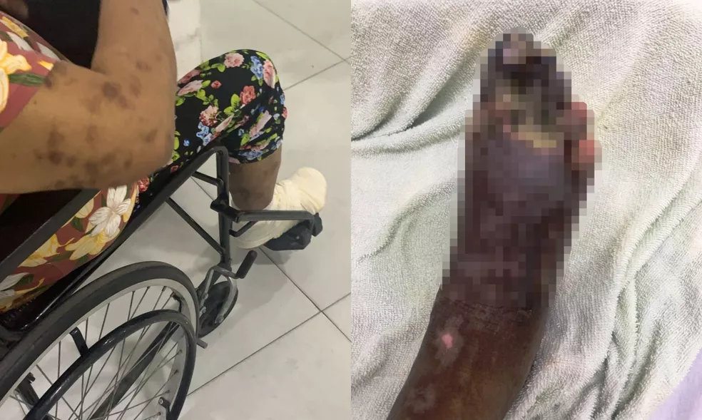 Mulher vê perna necrosar após ferir o pé e lutar nove dias por atendimento em SP: ‘verdadeiro descaso’