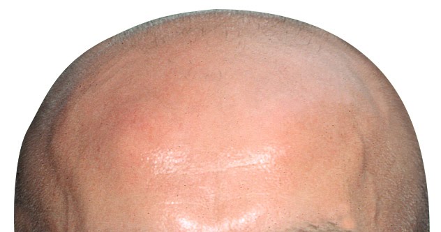 Justiça britânica determina que chamar um homem de ‘careca’ é uma forma de assédio sexual