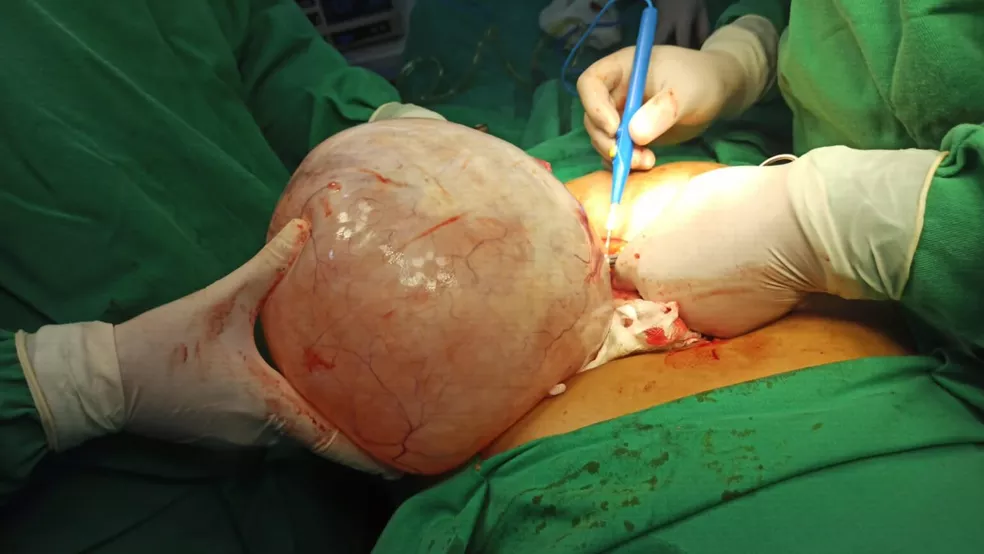 Médicos retiram cisto de 5 kg do ovário de idosa durante cirurgia de emergência no Sul do Piauí