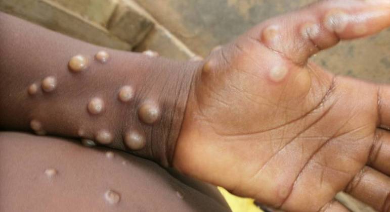Mato Grosso: primeiro caso suspeito de varíola de macacos é registrado