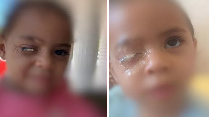 DF: Menina de 2 anos vai parar no hospital após grudar olho com cola