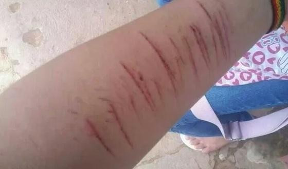 Com sinais de depressão, jovem de MT corta o próprio braço para chamar a atenção da mãe