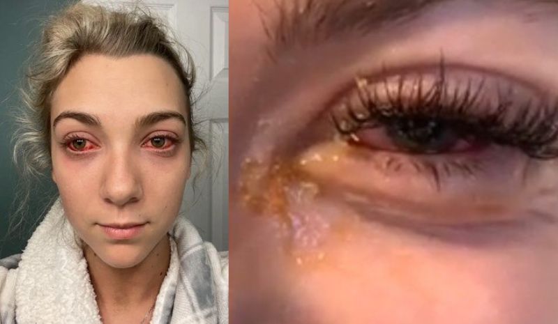 Jovem quase fica cega após fazer extensão de cílios: “Olhos de zumbi”