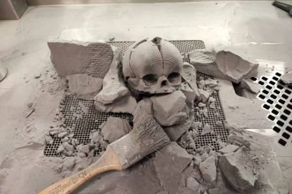 Bebê nasce sem parte do crânio e é operada com ajuda de tecnologia 3D