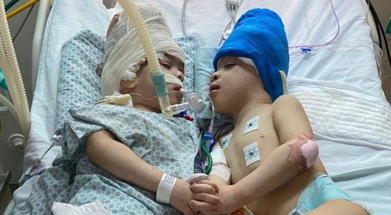 Após cirurgia de 27 horas, médicos brasileiros separam gêmeos siameses unidos pela cabeça