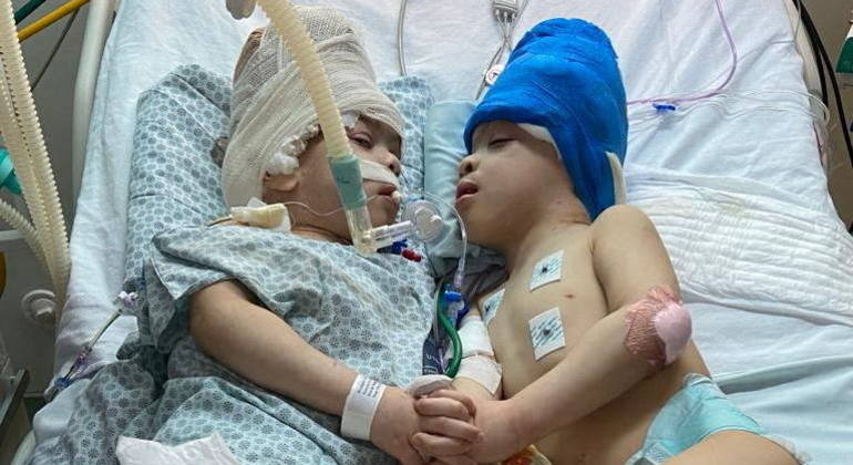 Após cirurgia de 27 horas, médicos brasileiros separam gêmeos siameses unidos pela cabeça
