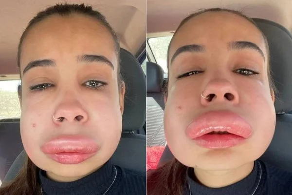Estudante tem reação alérgica bizarra ao reverter preenchimento labial