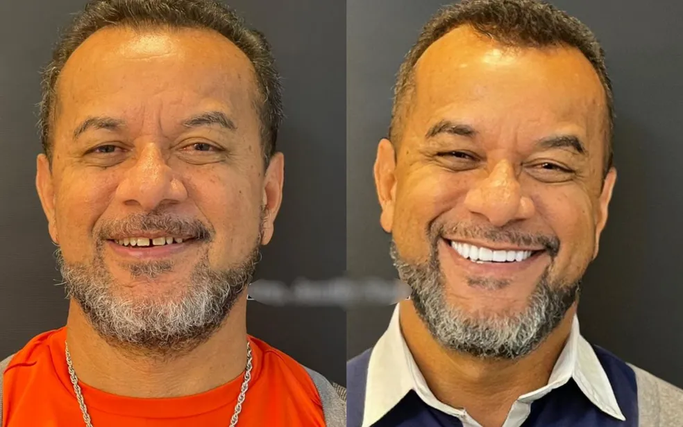 Funcionário público morre após ter infecção generalizada depois de colocar facetas dentárias, diz família