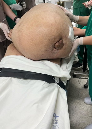 Morre mulher que teve tumor de 46kg retirado em cirurgia de emergência