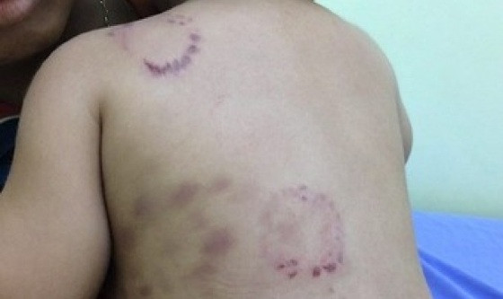 Criança vai parar em UPA com mordidas e cicatrizes feitas por padrasto