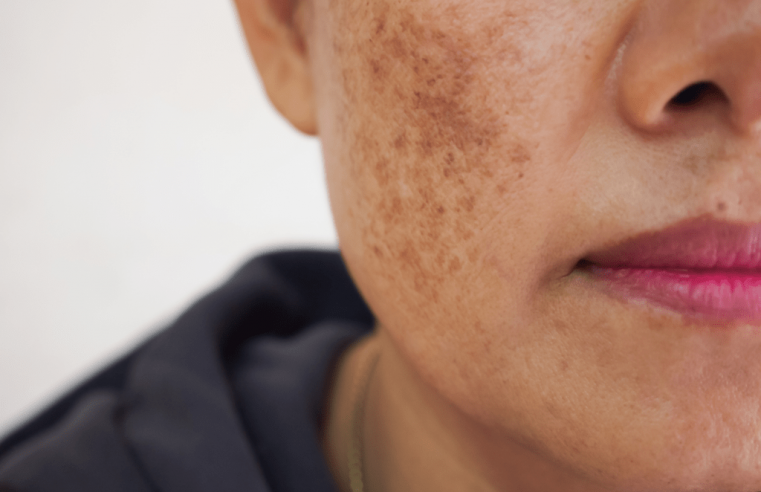 Médica desenvolve tratamento que reduz melasma em 50%