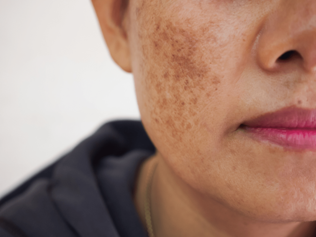 Médica desenvolve tratamento que reduz melasma em 50%